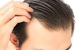 Hair Transplant Istanbul: Safe, Affordable, and Highly Effective