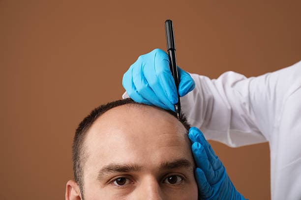 How Much Does Hair Transplant Cost in Top Turkish Clinics?