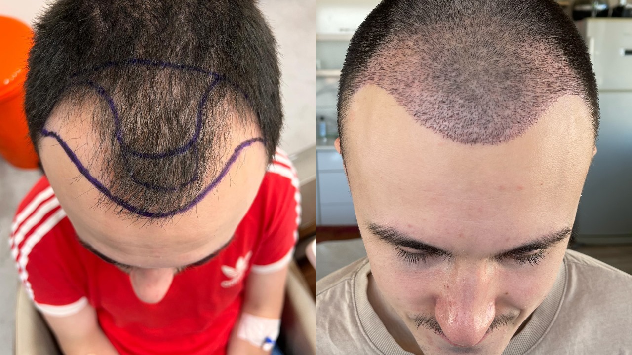 Hair Transplant London: What to Expect from Consultation to Recovery